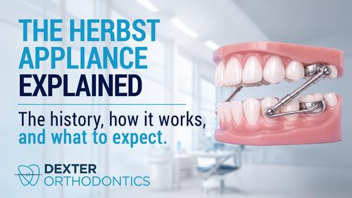 Close-up of an orthodontic teaching model showing a Herbst appliance mounted on the back teeth, illustrating how the fixed device gently guides jaw growth.